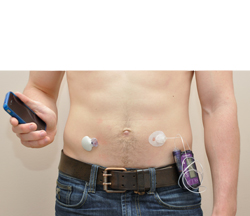 Pancréas artificiel externe : lecteur de glycémie en continu (à gauche), pompe à la ceinture qui injecte de l'insuline sous la peau du patient (à droite), contrôleur (ici un téléphone intelligent dans la main)