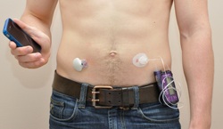 External artificial pancreas: continual glucose monitor (left), pump worn on the belt that injects insulin under the patient’s skin (right), and a controller (here, a handheld smart phone). Photo: IRCM
