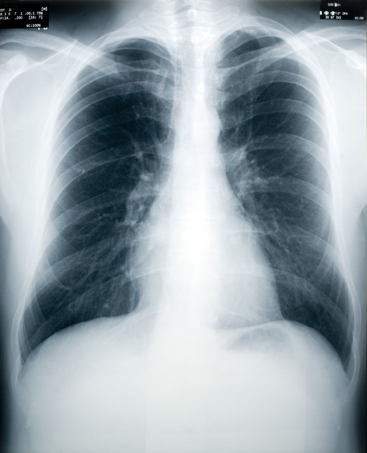 Tuberculosis Screening