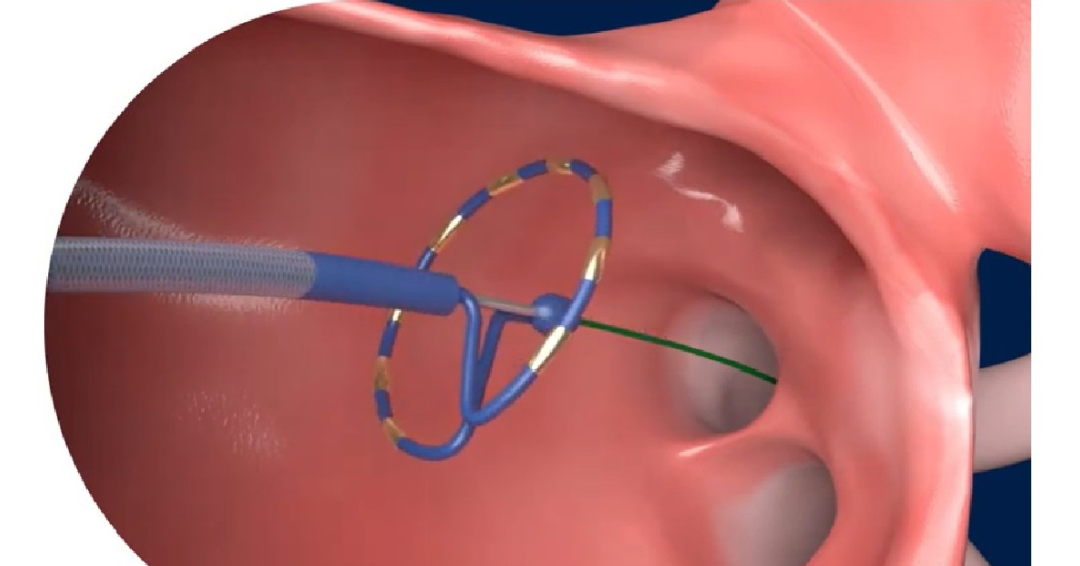 Leading The Way Towards Improved Treatment For Atrial Fibrillation   Banner News Brief Innovations In Cardiac Care 1 1 